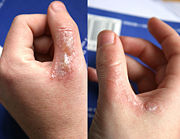 Watch for signs of oozing, blistering, rashes, etc.